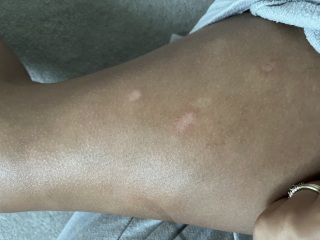 Help, patches on skin not going away pics included