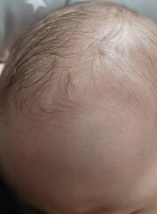 Cradle cap? 