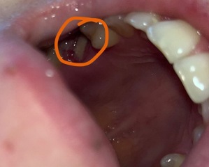 Tooth extraction, is this normal? 