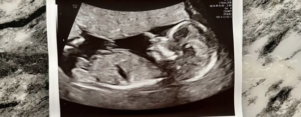 20 week scan on Wednesday, can anyone guess 💙🩷