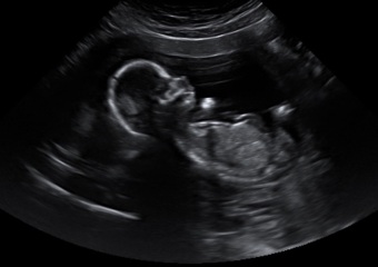 Nub theory - guess the gender!