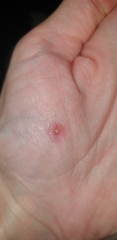 Wart help - using bazuka but it looks a bit wrong (photos)
