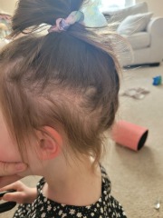 Hair loss in 4 year old