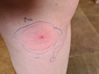 Would you be concerned by this bite?