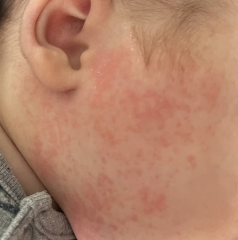 To eat dairy even though baby has suspected allergy?!