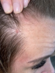 Red spot on scalp. 
