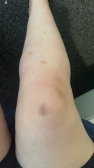 Should I go to gp with unexplained bruising (pics)