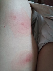 Insect bites