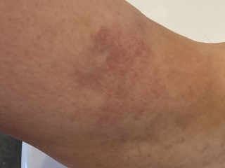 Spider/varicose veins *photos incl*