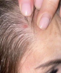 Red spot on scalp. 