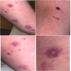 Bruising