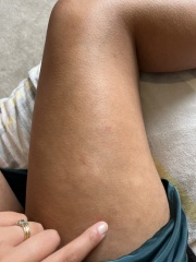 Weird patches on legs (pics)