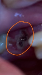Tooth extraction, is this normal? 