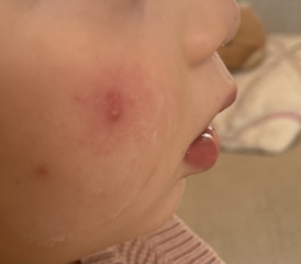 Recurrent spots on toddler’s face