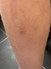Odd circular wounds on limbs - bites??