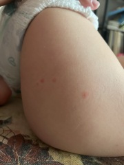  Chickenpox? 