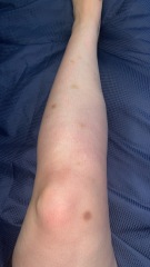 Should I go to gp with unexplained bruising (pics)