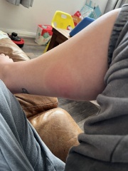 Bug bite - should I be worried???