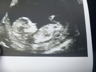 13 weeks pregnant and gender confusion