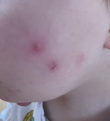 Recurrent spots on toddler’s face