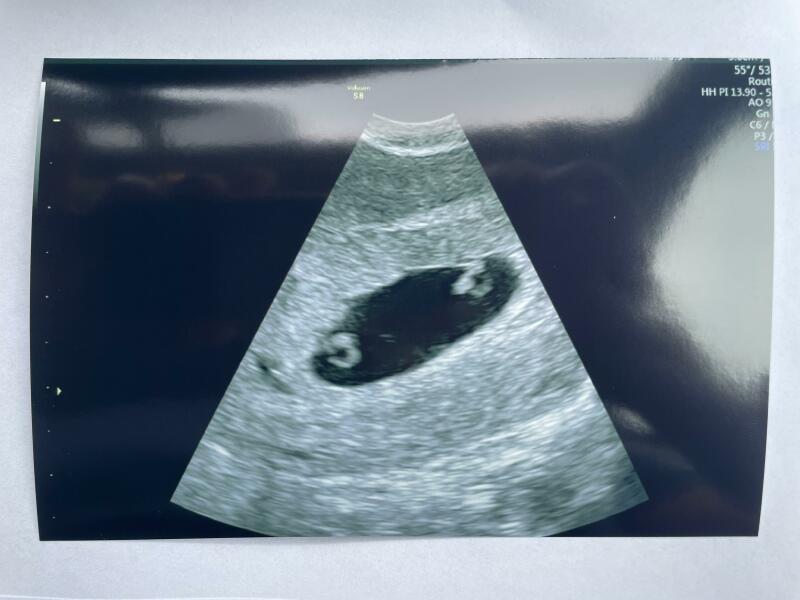 6 weeks pregnant- 2 babies!