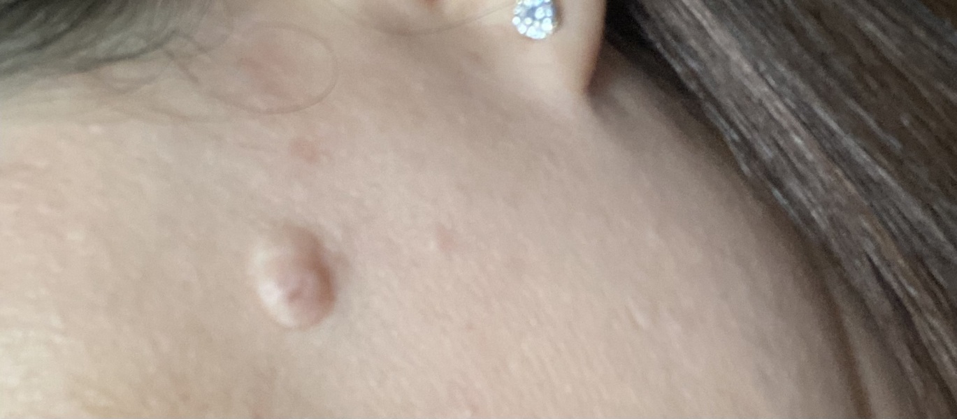 Mole or something else