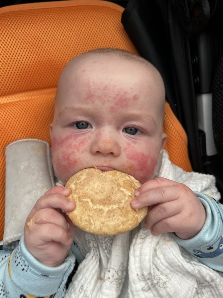 Is this facial rash baby eczema or not?