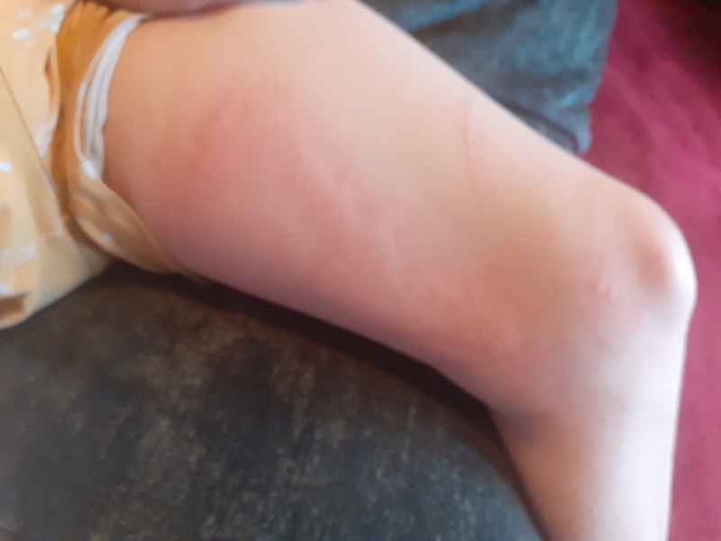 Werid rash on 8 yr old