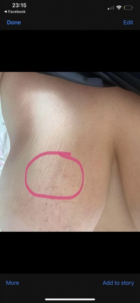 Breast indent
