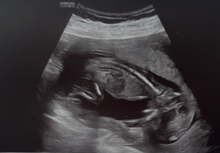 ERA/Alice/Emma infertility thread graduates/pregnancies