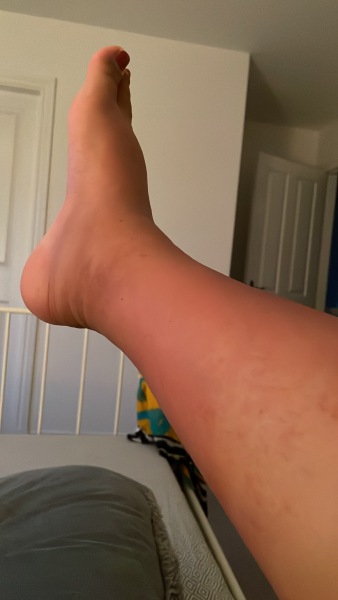 Ladies with pupps rash