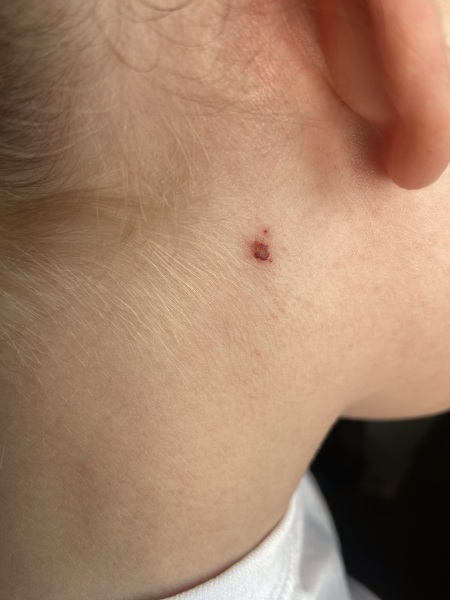 What’s this on my daughter’s neck?