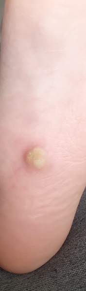 To ask what this is on Dc's foot? 