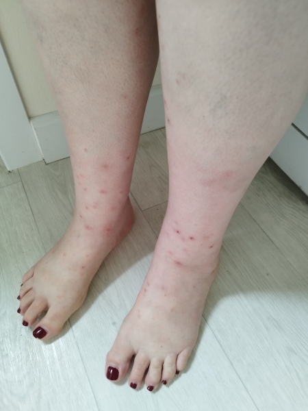 Our whole family (2 adults+2teens) have come out in hives, very itchy and annoying!