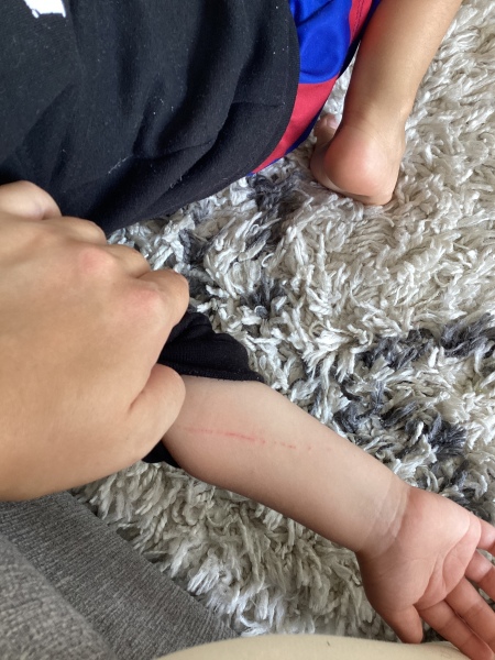 Severe health anxiety - does this cat scratch look ok?