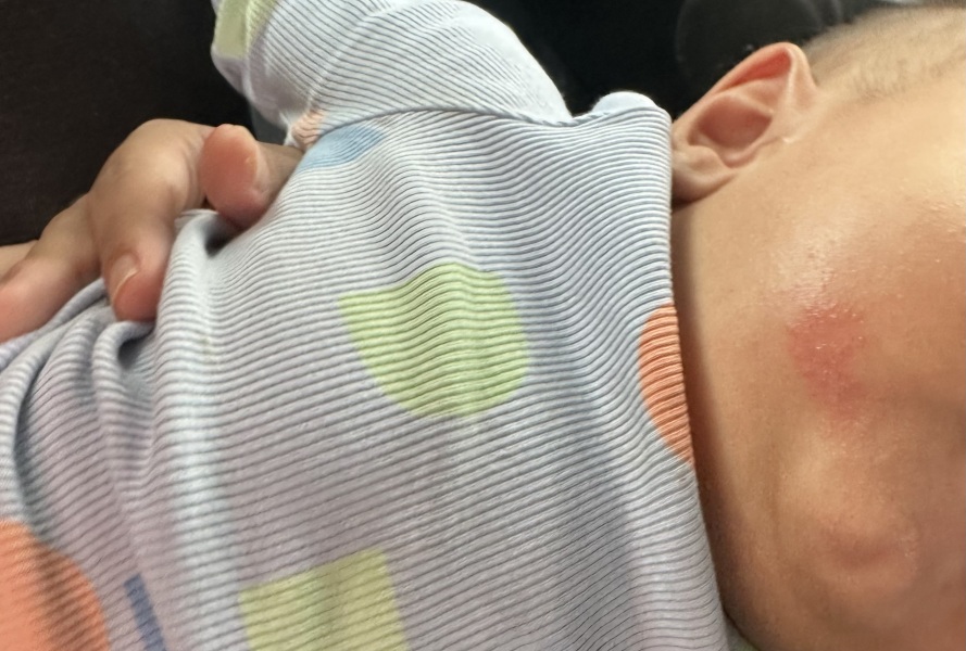 What’s this rash on my 8 month old’s face?