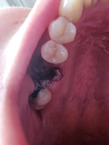 Can I interest anyone in a tooth extraction? (gross, sorry) 