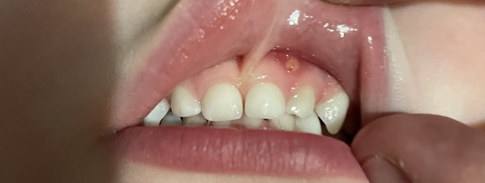 Spot on gum line 