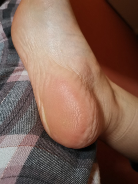 PLEASE HELP MY FOOT