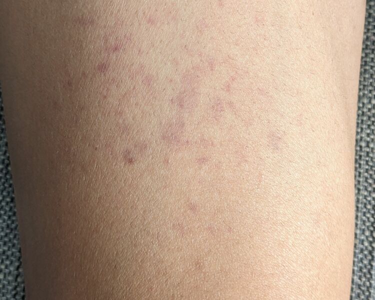 Purpura rash on thighs - with pictures