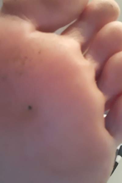 Something stuck in foot