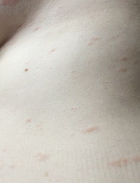 Rash while on med after FET