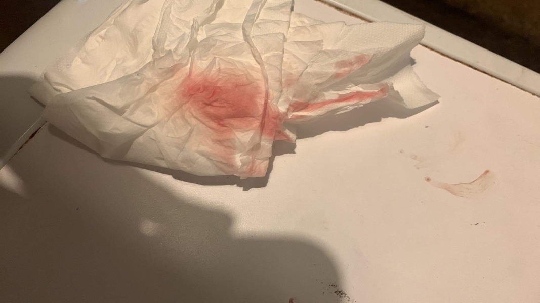 Pregnancy bleeding 
