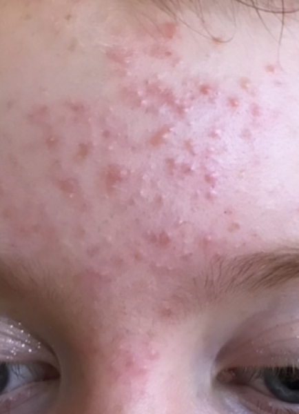 Is there any point approaching dr about dd’s bad skin?