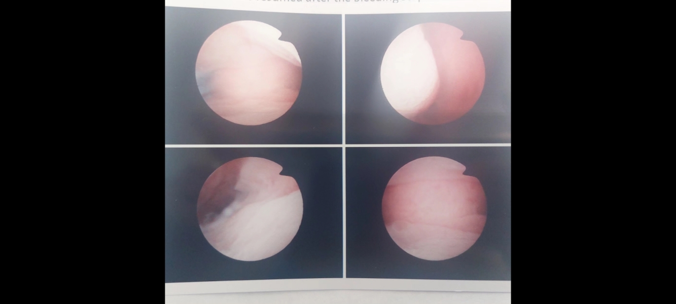 Sudden uterine polyp