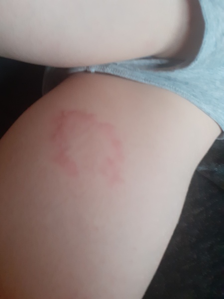Werid rash on 8 yr old