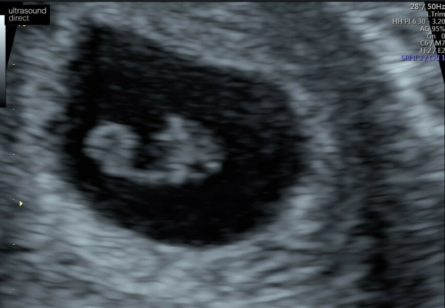 Can anyone share 8 week scan pictures?