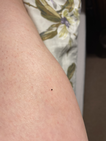 Does this look like a tick bite?