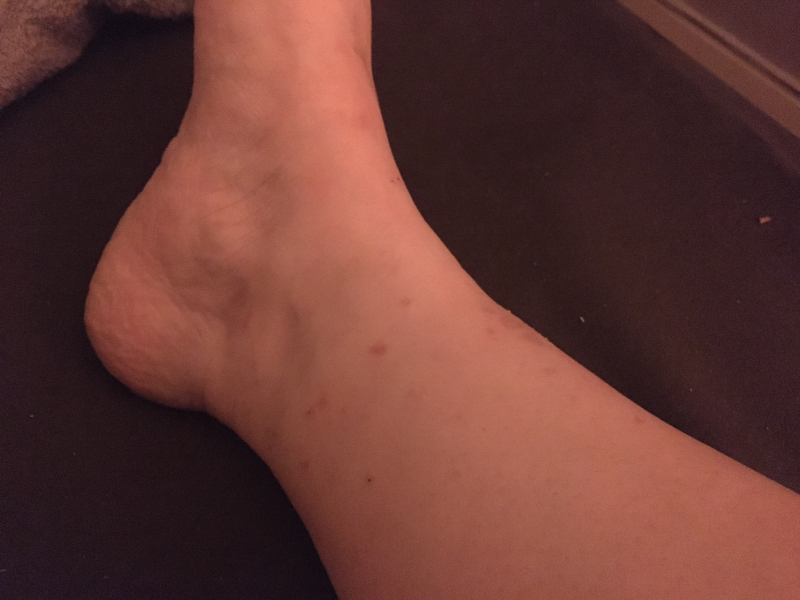 Help what bites are these 