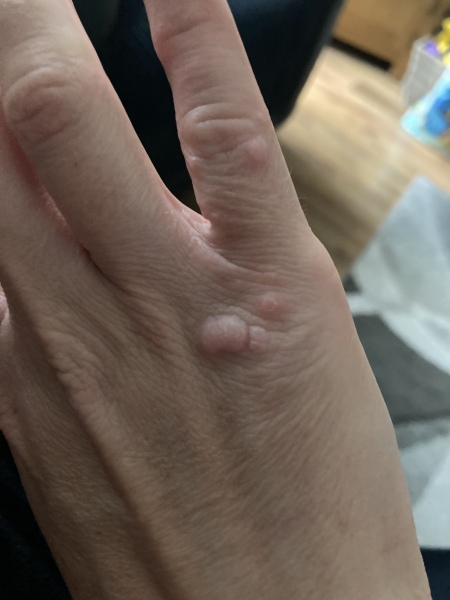 Stubborn warts